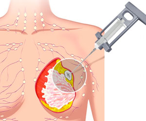 PAAF - Radiologia Intervencionista - CPM Tejerina