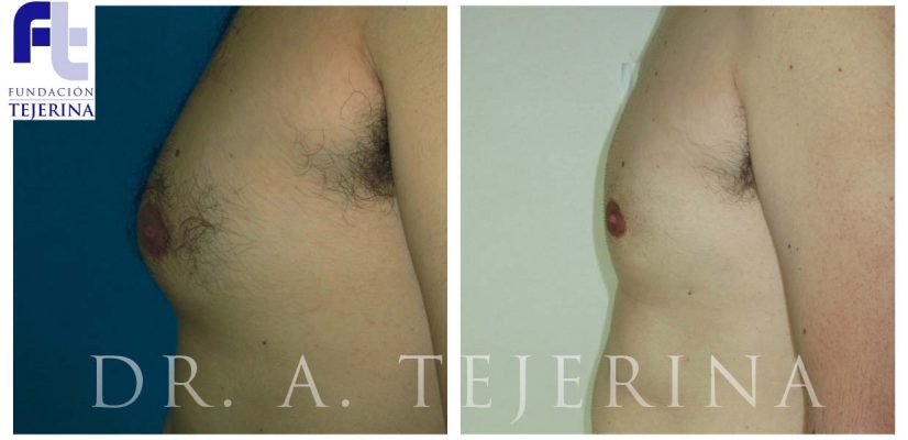 Reduccion mama en el varón - Ginecomastia - Cirugía de mama - Cpm Tejerina