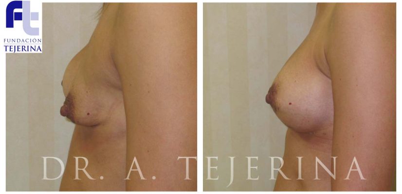 Asimetria Mamaria Caso 1 - Cirugia de Mama - CPM Tejerina