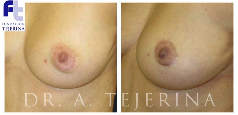 Disminucion de Areola - Cirugia de Mama - Cpm Tejerina