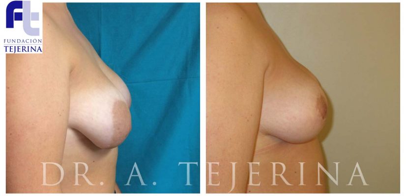 Mama Tuberosa - Cirugía de mama - Cpm Tejerina