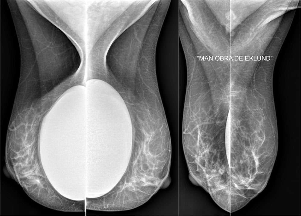 Maniobra Eklund - Recambio de implantes - CPM Tejerina