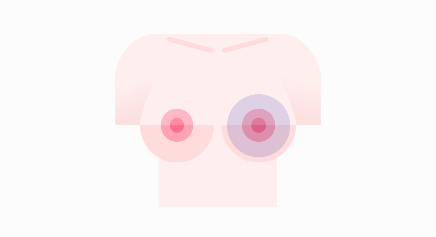 cirugia pecho 05