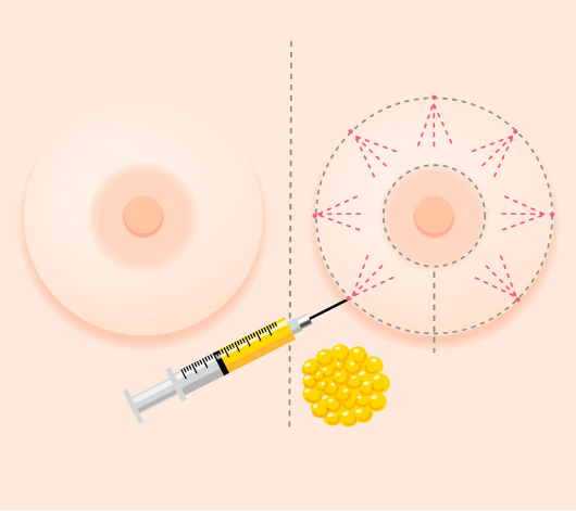 lipolifting01
