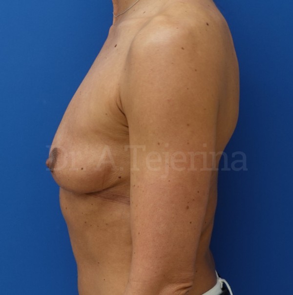 pro 2 despues – 18
