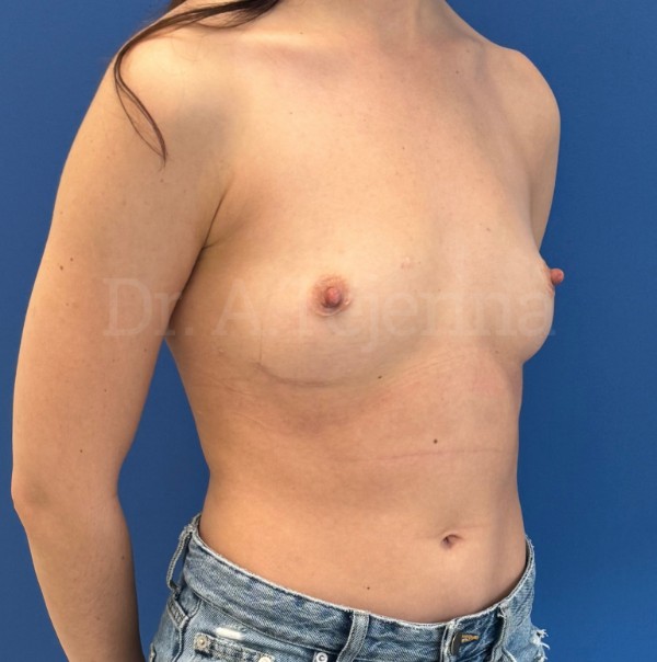 pro 2 despues – 7